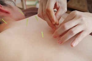 鍼治療 鍼治療